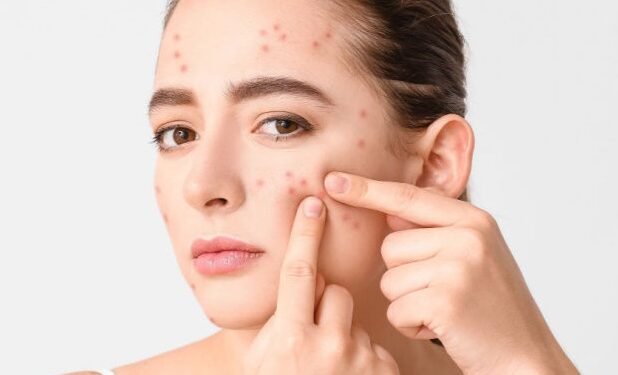 चेहरे पर पिंपल्स स्वास्थ्य के बारे में देते हैं कई जानकारी, यहां जाने क्या कहते हैं एक्सपर्ट…