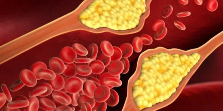 अगर चेहरे पर नजर आ रहे हैं यह पांच लक्षण ,तो हो सकते हैं बेड कोलेस्ट्रॉल के लक्षण…