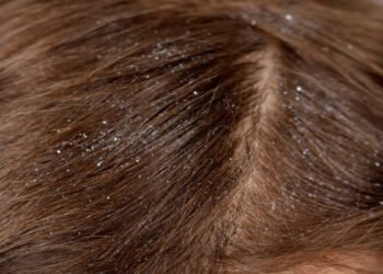 रूसी आपको बना सकता है गंजा, इसे न करें नजरअंदाज, जानें क्यों बार-बार बालों में आती है डैंड्रफ…