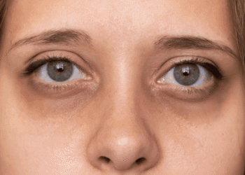 अगर आपके आंखों के नीचे काले घेरे जड़ से हो जाएंगे खत्म सोने से पहले कर लें ये 1 काम…