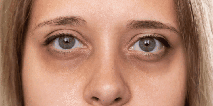 अगर आपके आंखों के नीचे काले घेरे जड़ से हो जाएंगे खत्म सोने से पहले कर लें ये 1 काम…